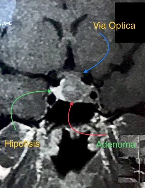 RMN evidencia adenoma hipofisario que lateraliza la glándula hacia la derecha, con invasión parcial de seno cavernoso izquierdo y alcanza la vía óptica.