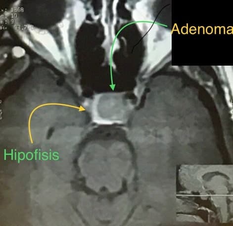 En esta resonancia observamos cómo el adenoma en su crecimiento desplaza la glándula hacia la periferia.