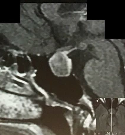 RMN evidencia adenoma hipofisario en región selar.