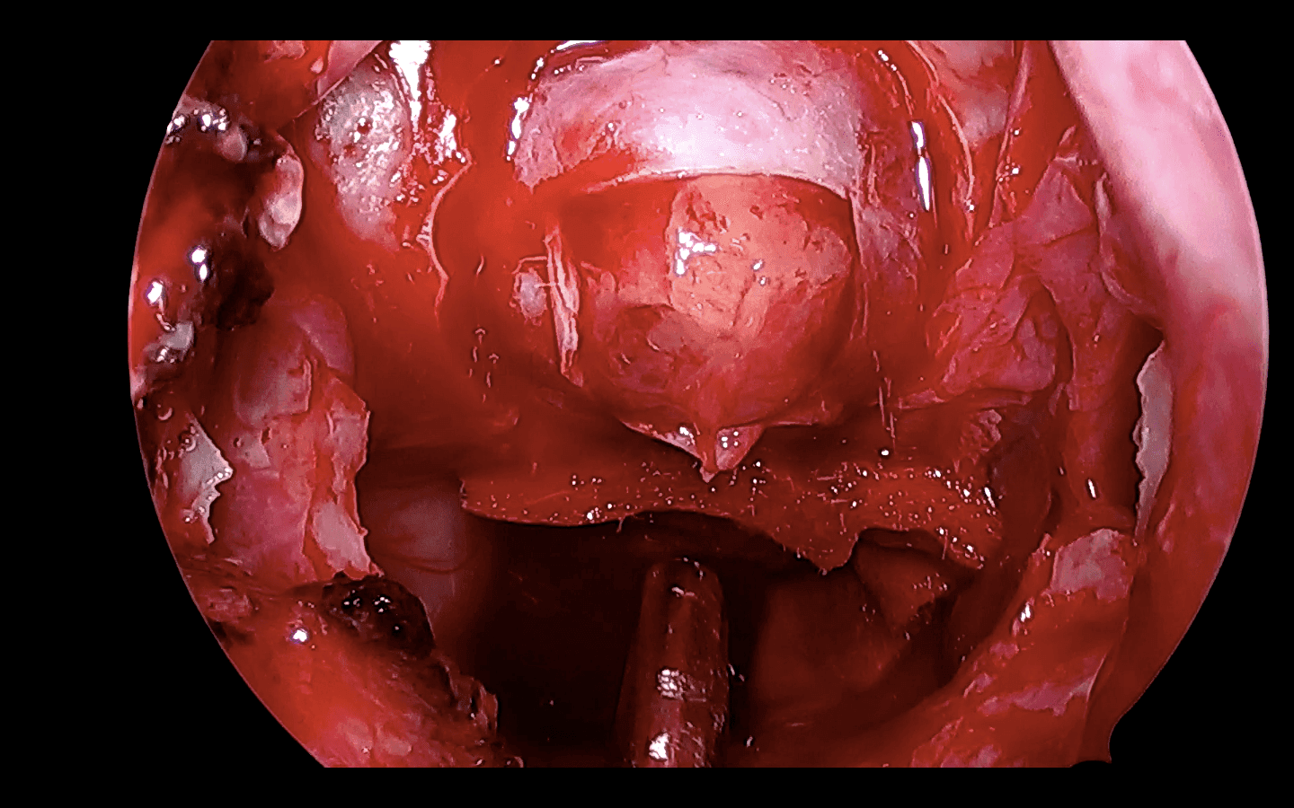 Luego de la apertura dural evidenciamos el adenoma selar.