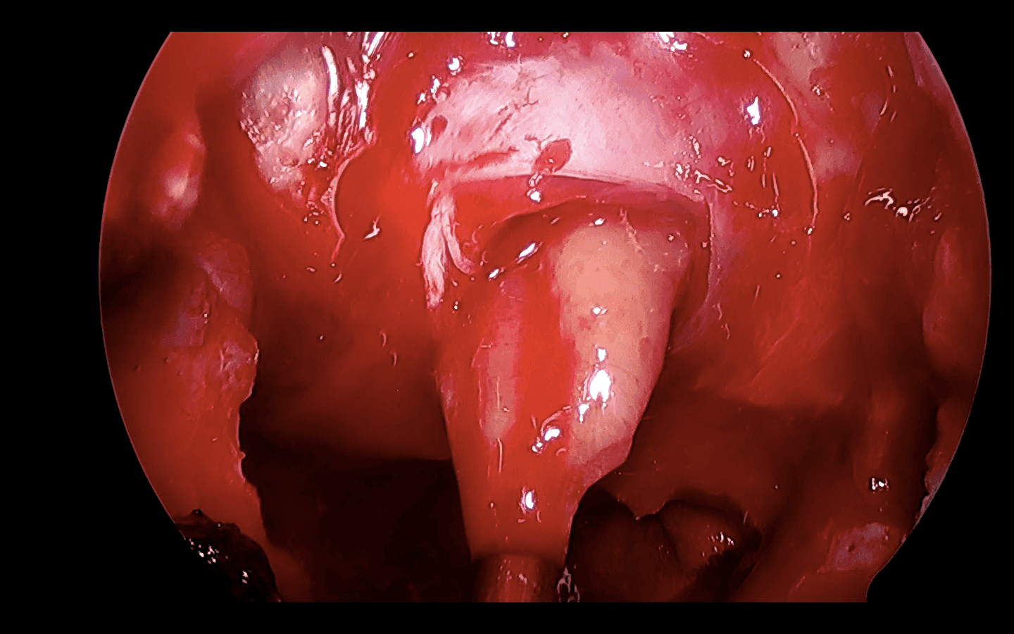 Avanzada la disección observamos cómo el tumor comienza a salir de la región selar.
