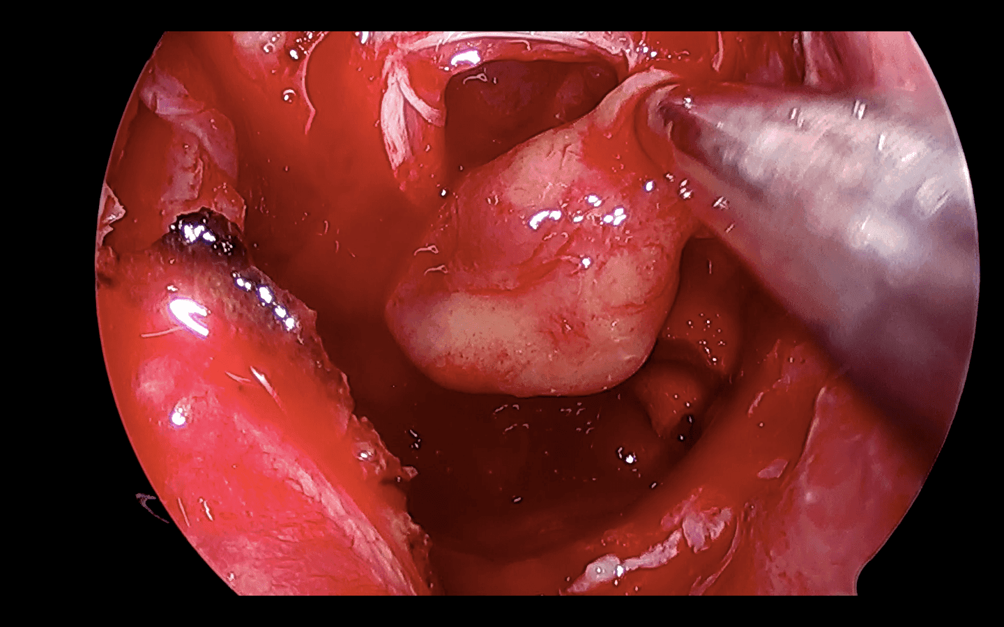 Adenoma hipofisario completamente fuera de la silla turca.