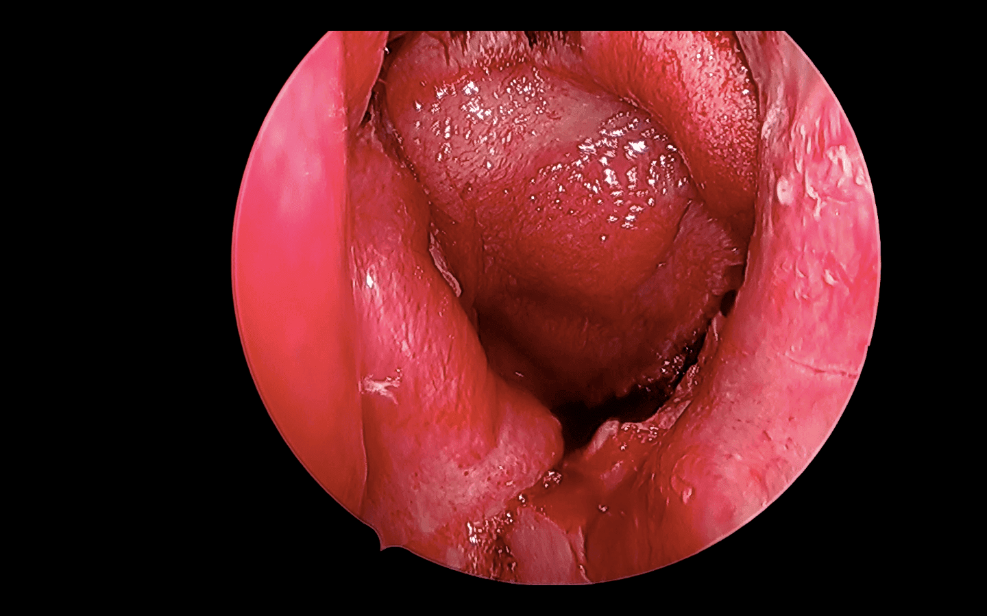 Reconstruimos el defecto en la base del cráneo con el flap nasoseptal para minimizar los riesgos de fístula de líquido cefalorraquídeo.