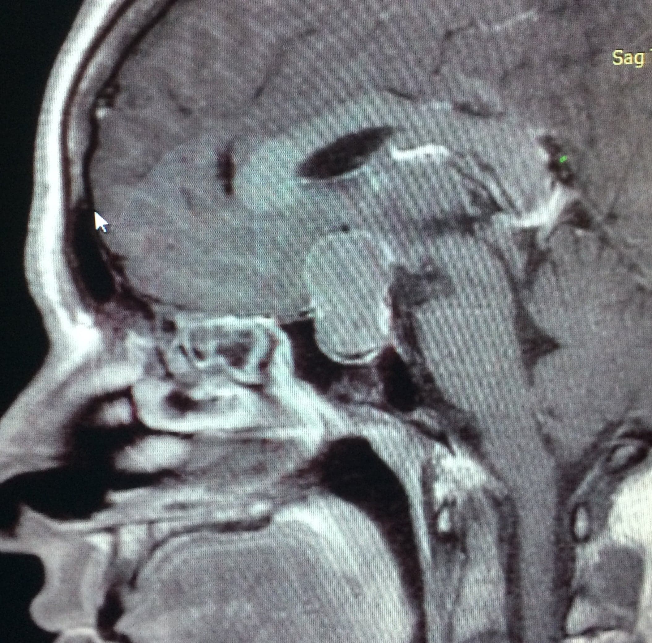 Adenomas Hipofisarios