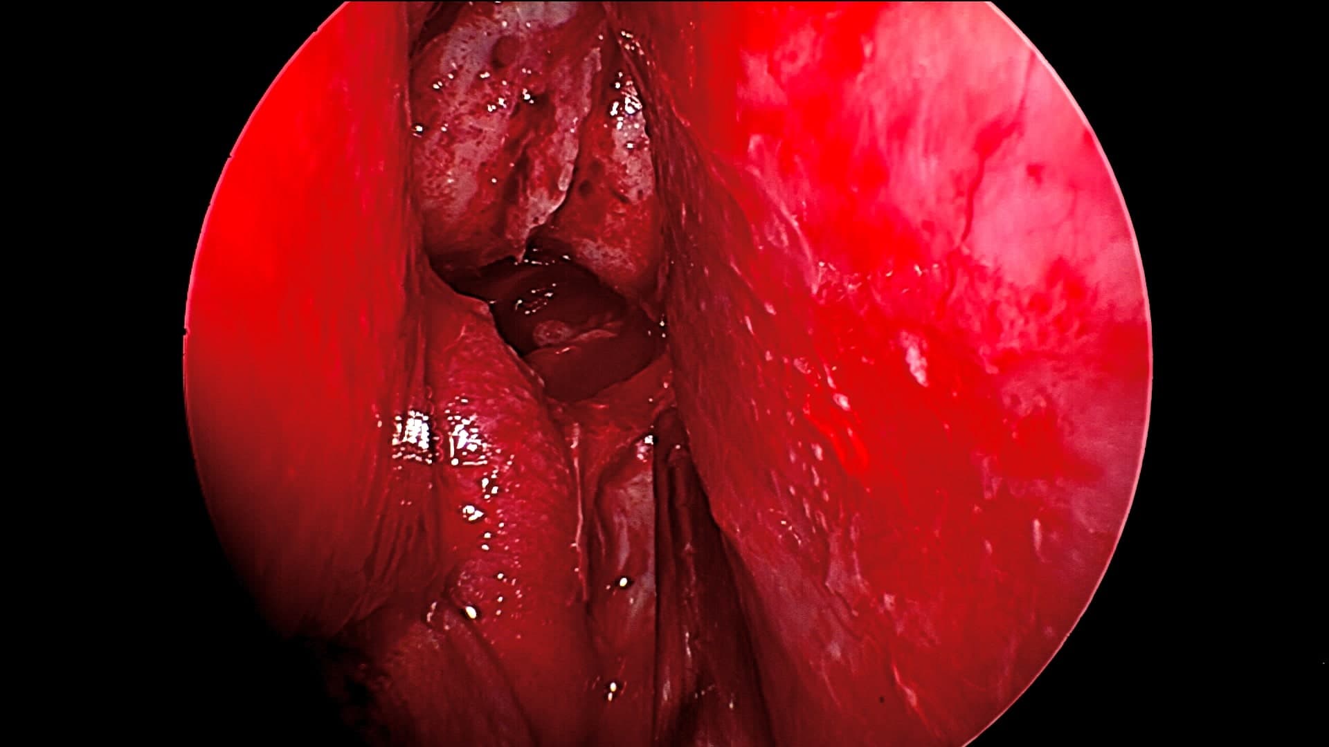 Podemos visualizar el corredor que nos ofrecen las fosas nasales para llegar a la silla turca donde se originan los adenomas hipofisarios. A la izquierda cornete medio, a la derecha tabique nasal, al centro y en profundidad visualizamos la silla turca agrandada por el tumor.