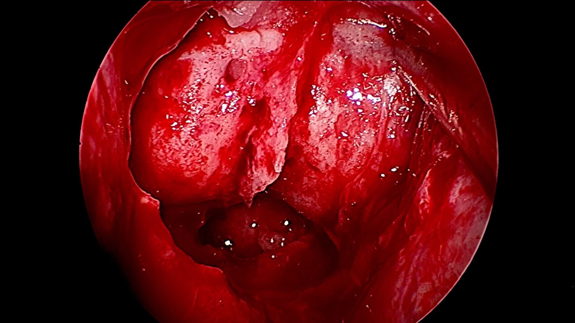 Al progresar el endoscopio visualizamos a silla turca aumentada de tamaño al detalle.