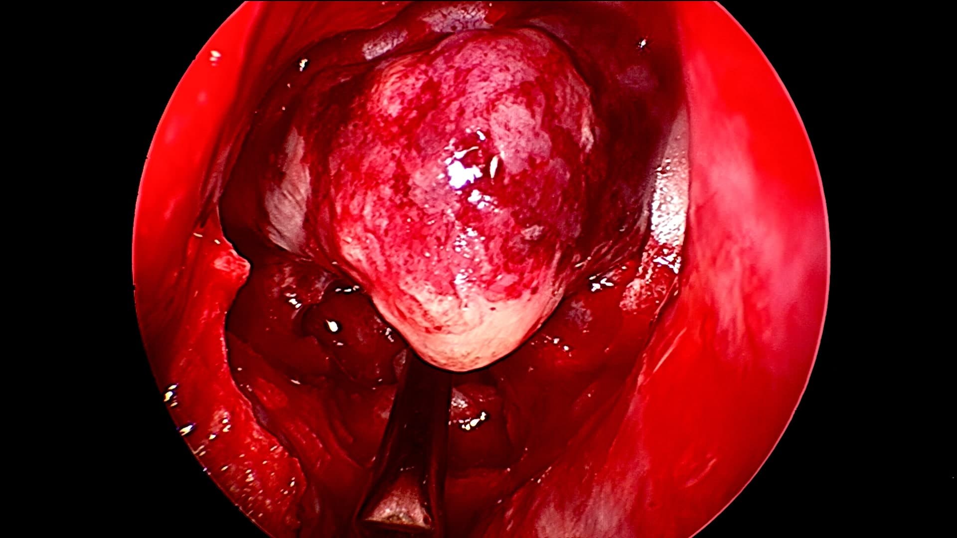 Al realizar la apertura dural vemos cómo el tumor comienza a salir de la región selar, protruyendo hacia el seno esfenoidal y fosas nasales.