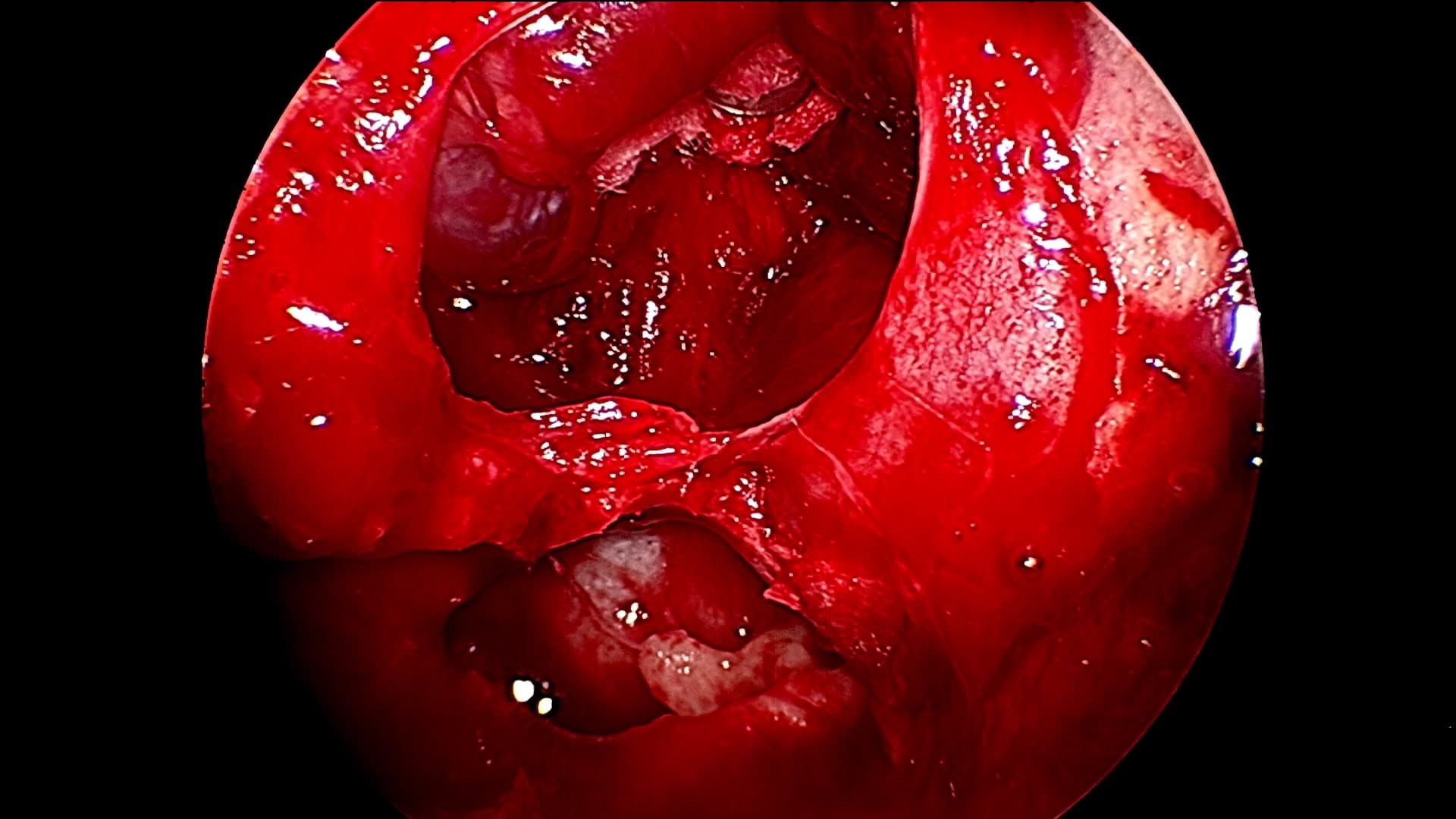 Vista final luego de la resección total del adenoma. Nótese como la visión endoscópica permite visualizar la correcta resección tumoral.