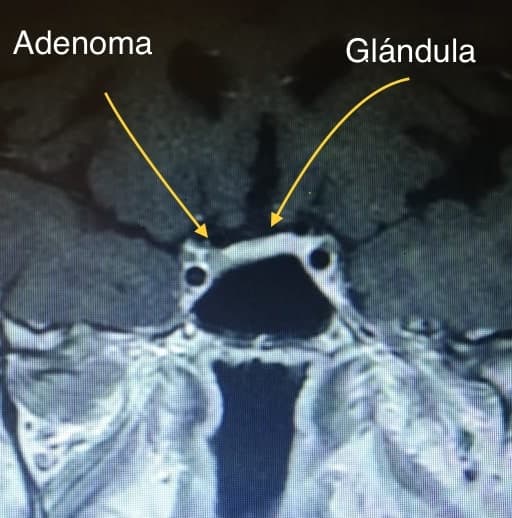 La resonancia magnética nuclear evidencia microadenoma de 2 mm lateralizado a la derecha de la glándula hipofisaria y en contacto con arteria carótida interna derecha, en una paciente con diagnóstico de Enfermedad de Cushing.