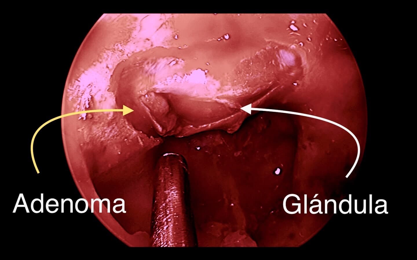 Imagen endoscópica intraoperatoria donde se evidencia microadenoma lateralizado y glándula hipofisaria normal.