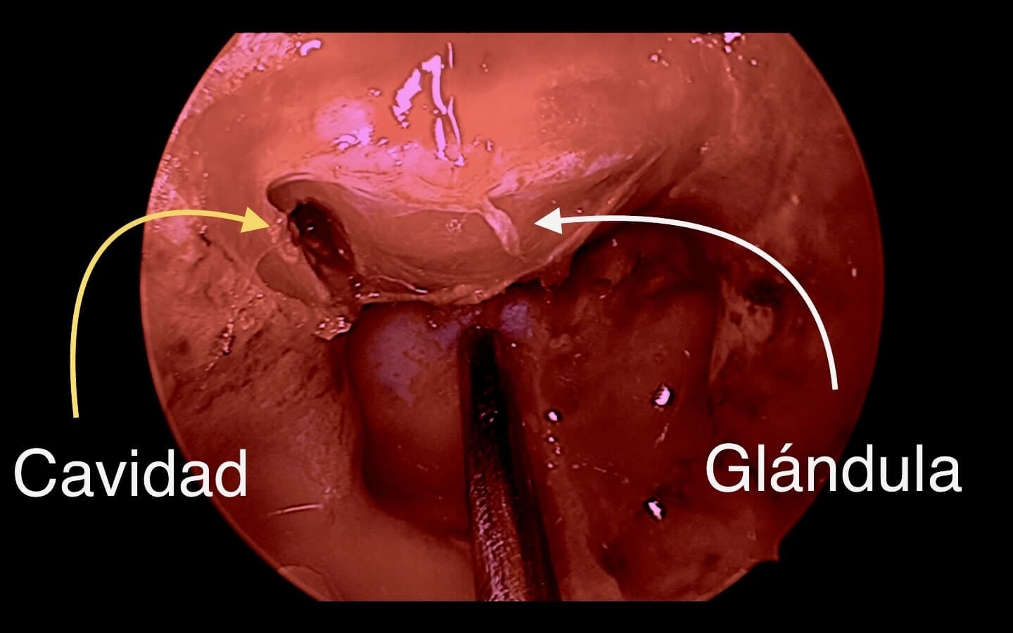 Luego de la resección total del microadenoma se evidencia cavidad vacía y la glándula hipofisaria respetada.