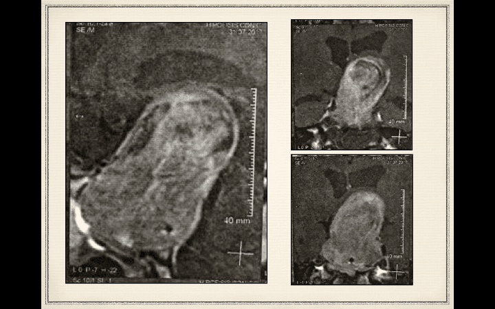 RMN evidencia adenoma gigante de aproximadamente 7 cm en su eje máximo y el desplazamiento hacia superior del tejido cerebral.