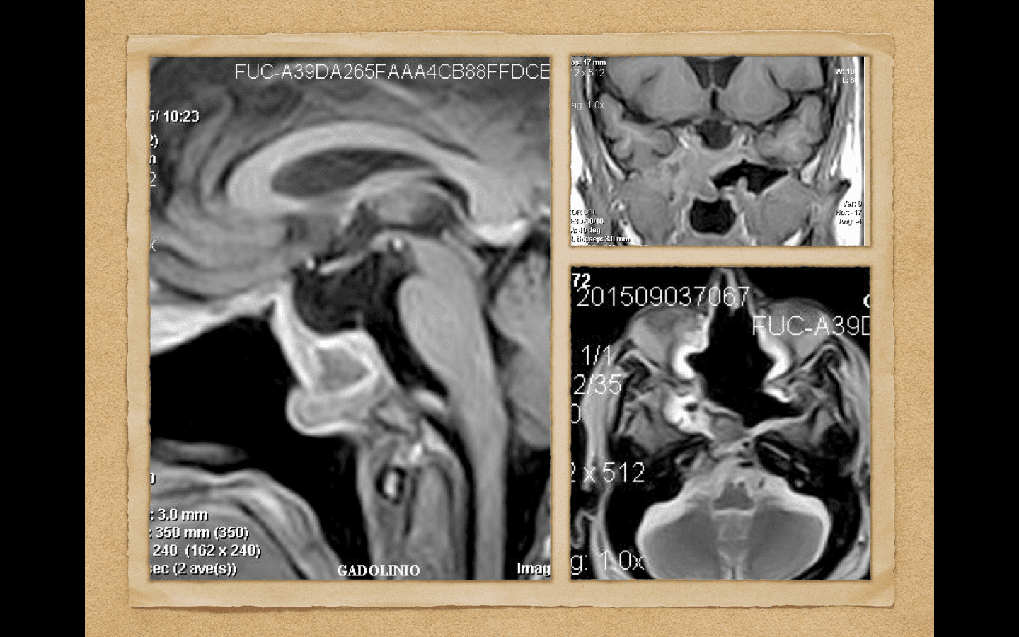 RMN postoperatoria evidencia resección completa de la lesión y correcta descompresión de elementos neurales.