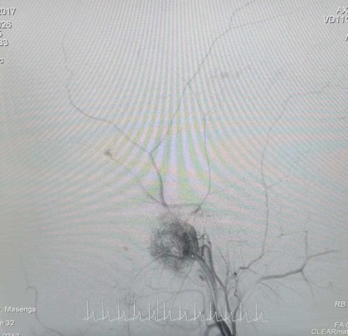 Vascularización dependiente de arteria maxilar derecha.