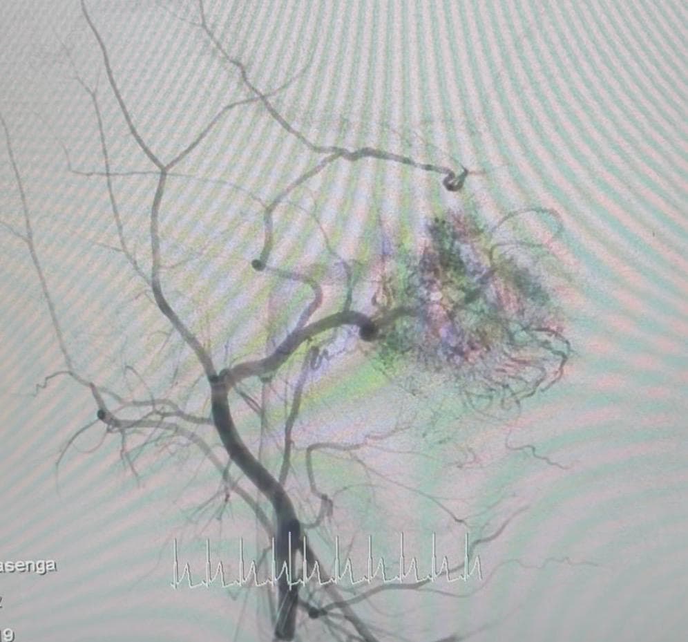 Tumor irrigado principalmente por arteria maxilar interna derecha.