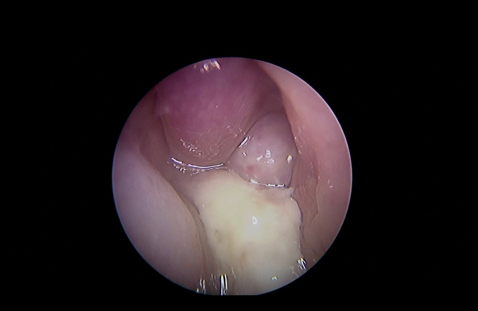Tumor en la fosa nasal derecha. Vista endoscópica inicial que muestra la extensión tumoral ocupando la cavidad nasal derecha.