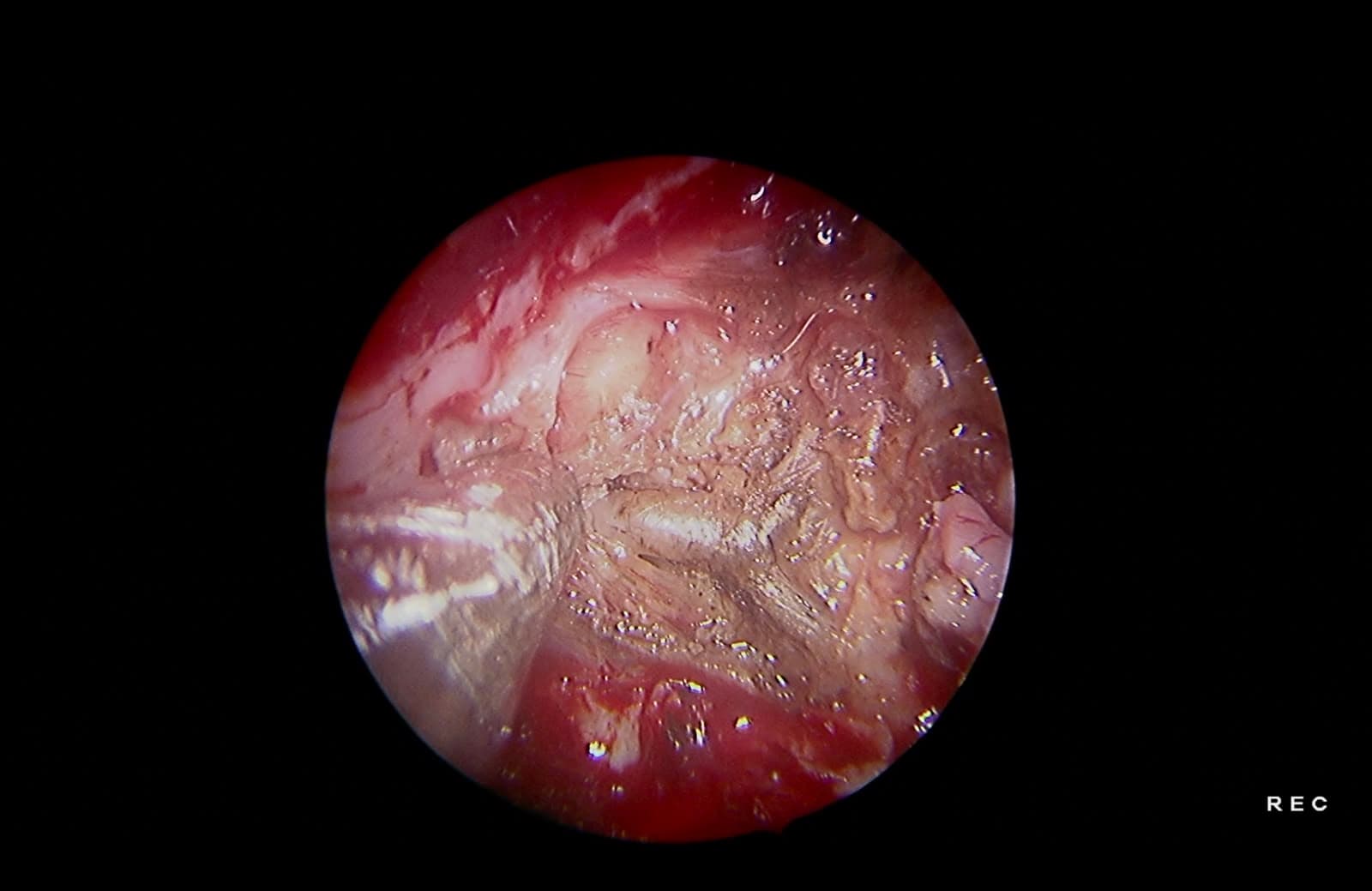 Identificación de la arteria maxilar interna. Exposición de la arteria maxilar interna en la fosa infratemporal para su control y sección, reduciendo el sangrado durante la cirugía.