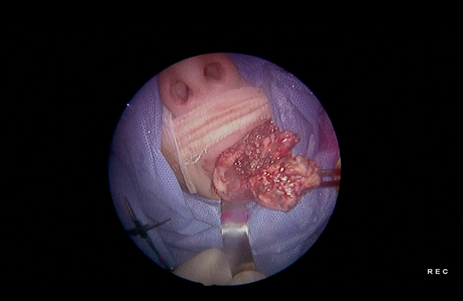 Extracción tumoral por vía transoral. Parte del tumor es movilizada y retirada a través de la cavidad oral.