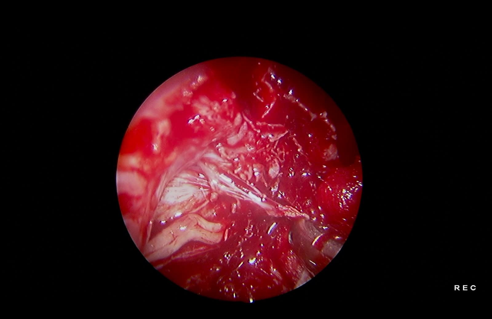 Disección del seno cavernoso. Se identifican estructuras neurovasculares críticas, incluyendo el nervio maxilar (V2), el nervio oftálmico (V1), la pared lateral del seno cavernoso y la duramadre del polo temporal.
