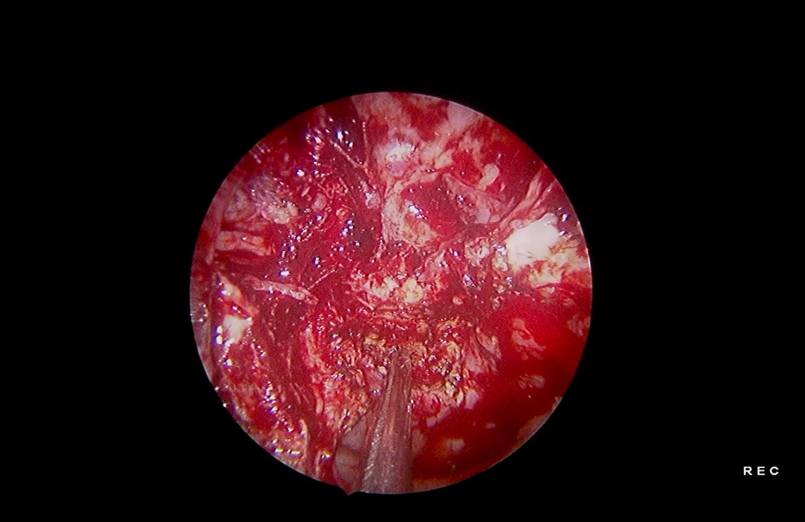 Lecho quirúrgico final. Control endoscópico al finalizar la cirugía. Se observa la silla turca, la nasofaringe y la fosa pterigopalatina libres de tumor, así como el seno cavernoso derecho sin evidencia de enfermedad residual.