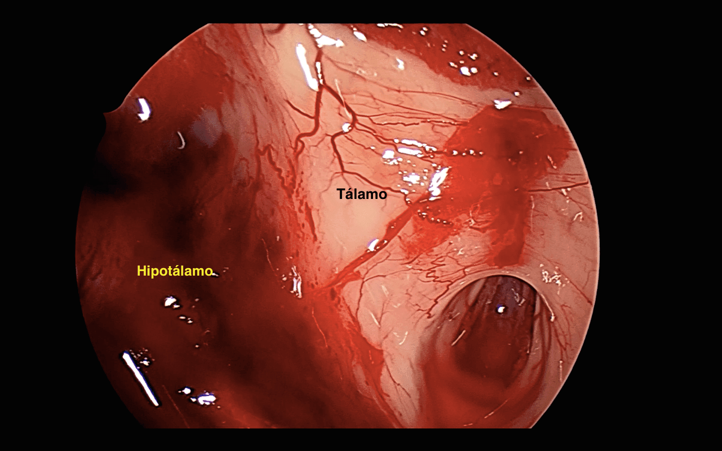 Girando la óptica a la derecha vemos al hipotálamo derecho cruento luego de la resección tumoral ya que es el sitio de adherencias más común. Esta imagen se condice con el corte coronal de la resonancia preoperatoria.