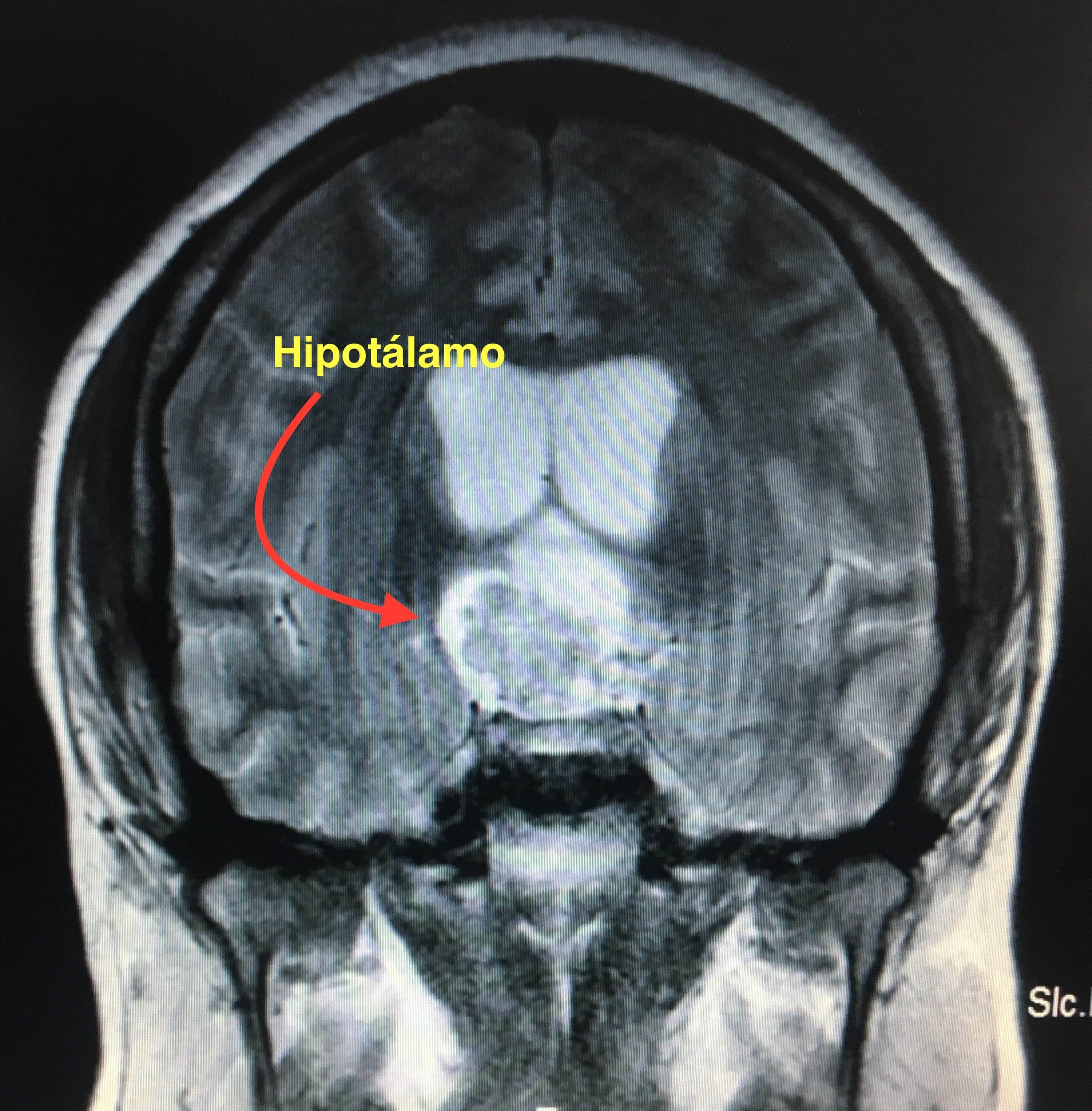 En el corte coronal observamos que el tumor genera edema en el Hipotálamo derecho. Compare este hallazgo por imágenes con la visión endoscópica intraoperatoria en la cual se aprecia la superficie cruenta del Hipotálamo derecho.