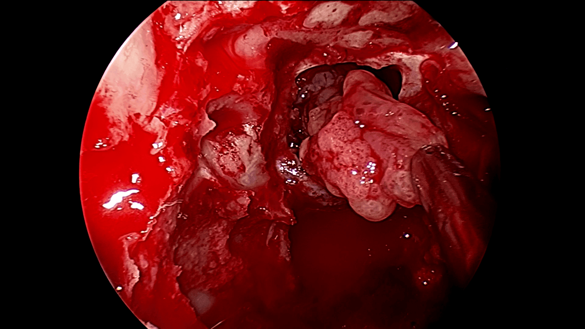 Podemos ver cómo resecamos la parte sólida del tumor por la vía endoscópica.