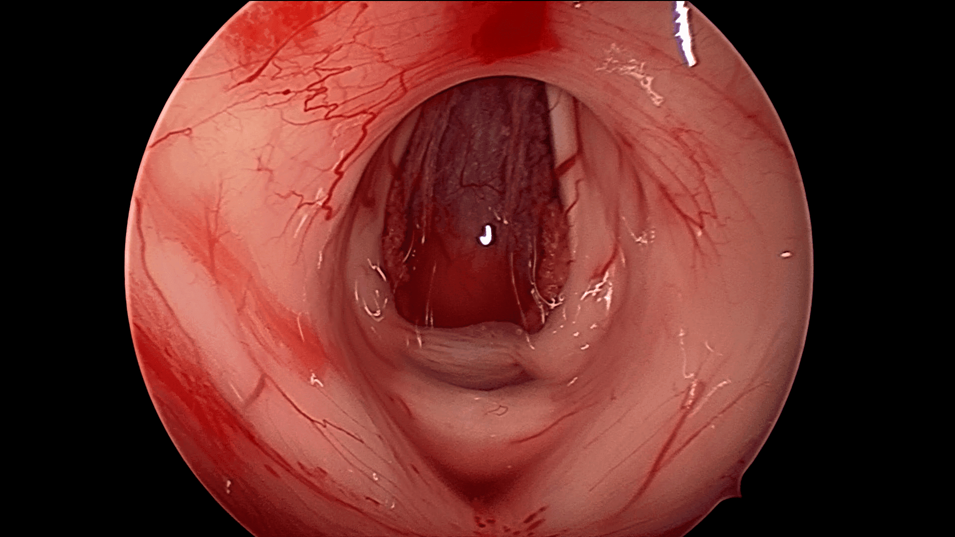 Recién luego de realizar la resección total del tumor podemos ver parte del cerebro normal, el techo del tercer ventrículo libre de tumor.