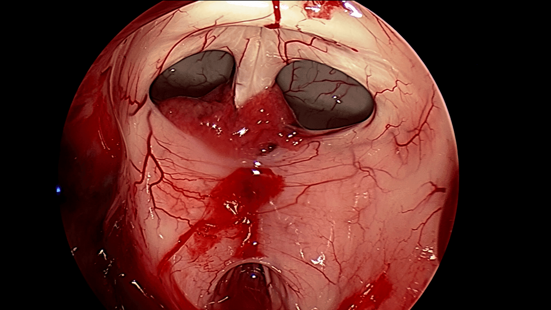 Utilizando una óptica angulada podemos ver los forámenes de Monro y el tercer ventrículo libre de tumor.