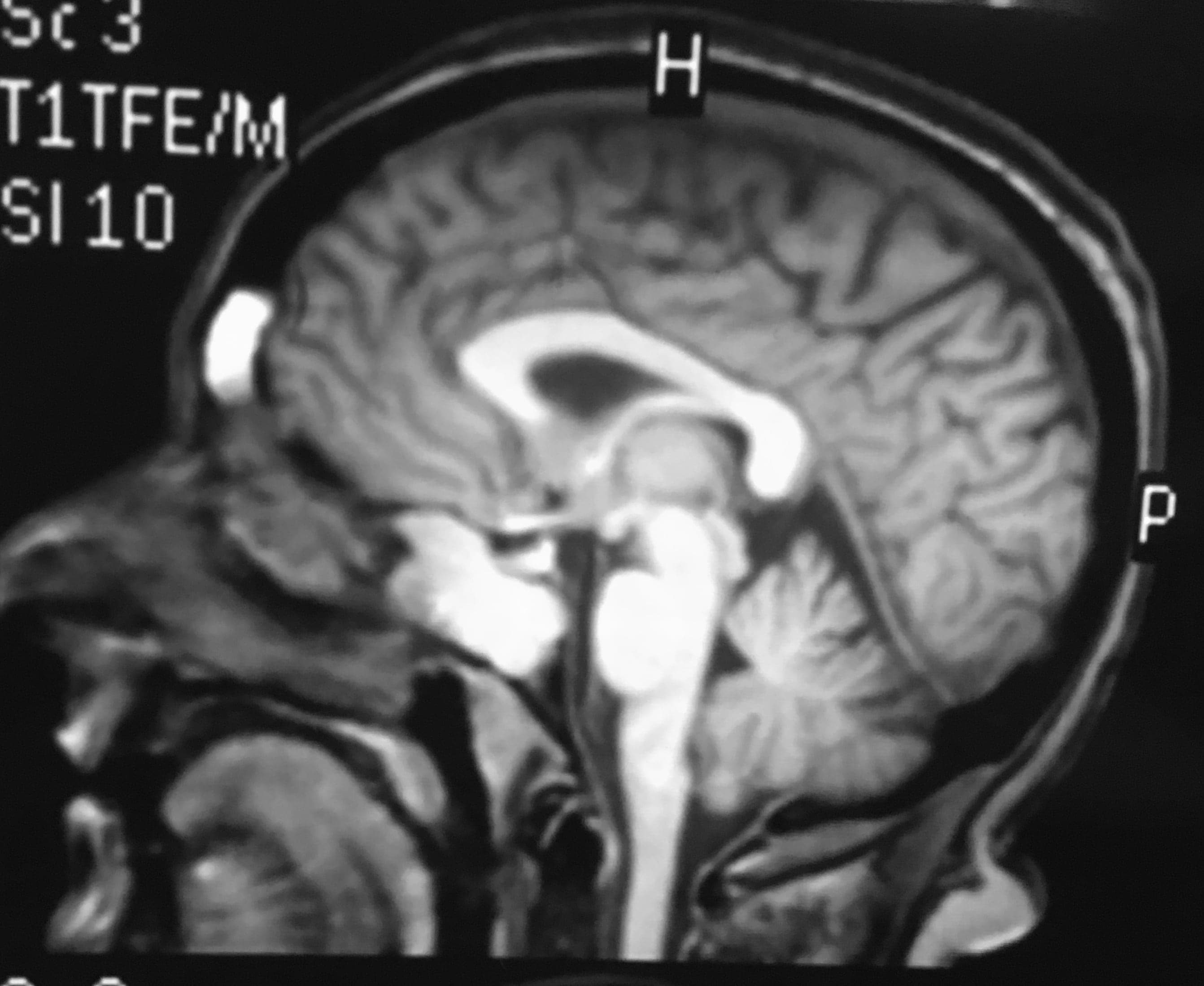 Estesioneuroblastoma o Neuroblastoma olfatorio