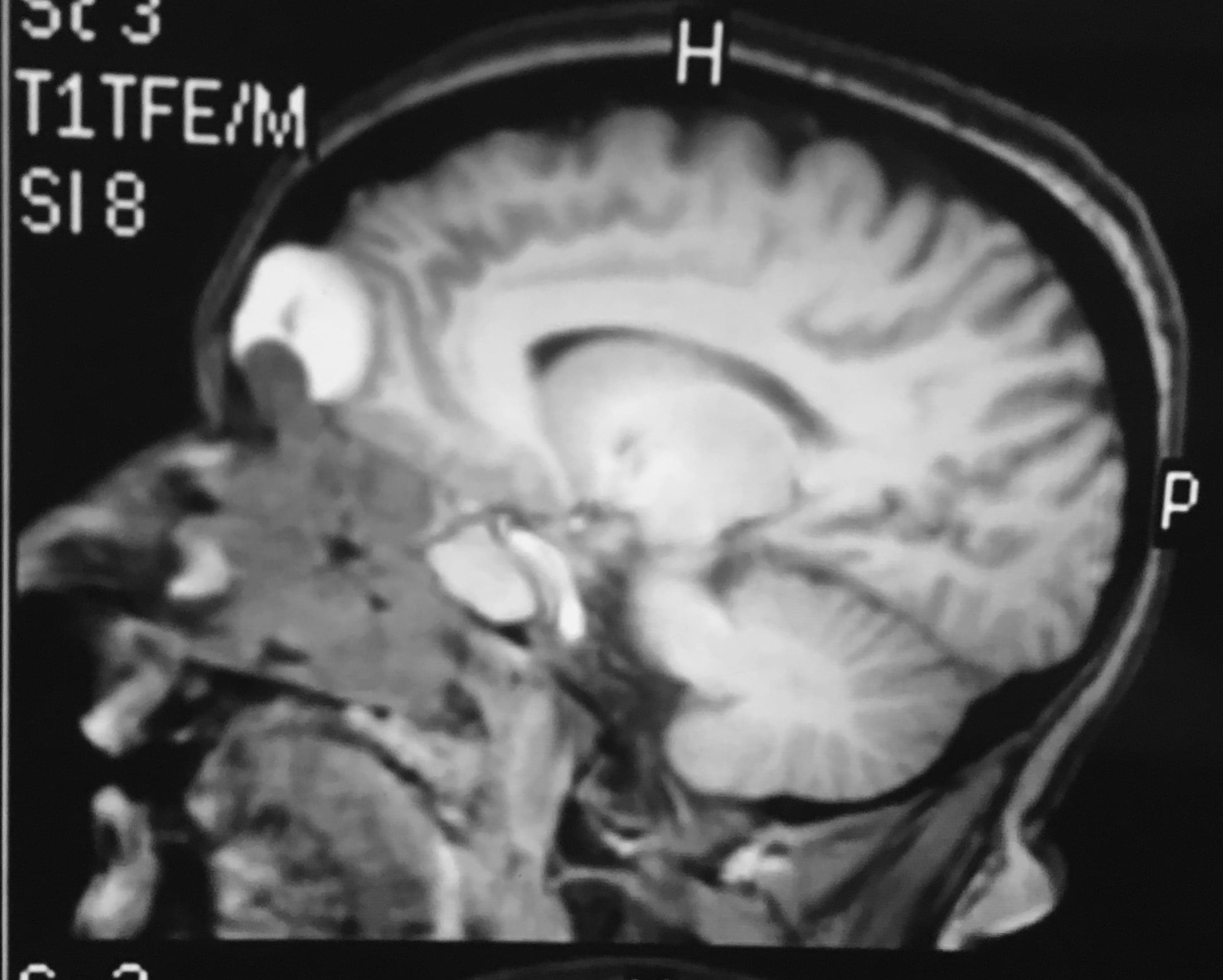 Estesioneuroblastoma o Neuroblastoma olfatorio