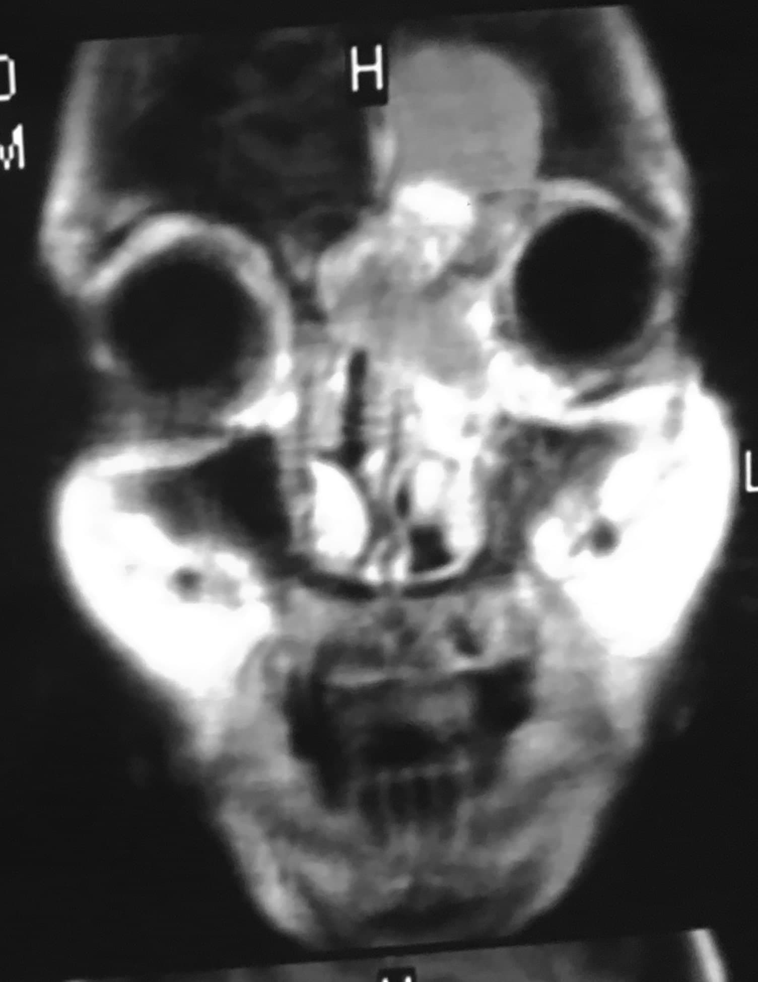 Estesioneuroblastoma o Neuroblastoma olfatorio