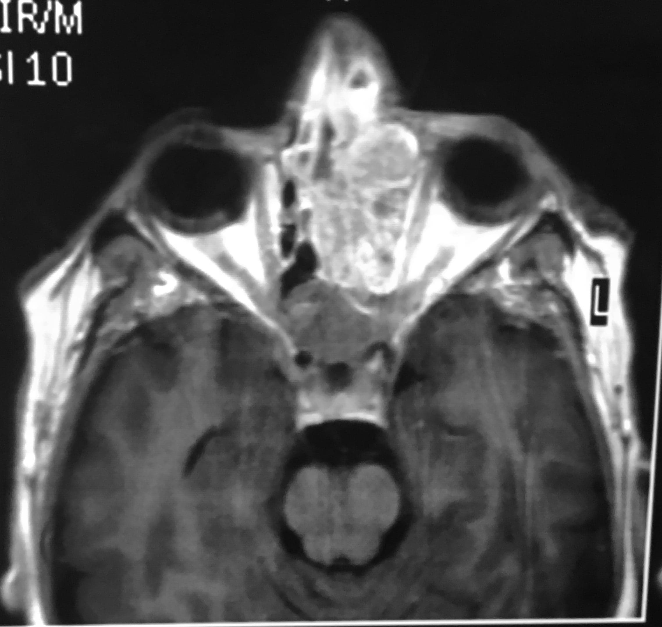 En esta paciente se realizó resección total por vía endoscópica endonasal sin necesidad de realizar craneotomía y posteriormente tratamiento radiante.