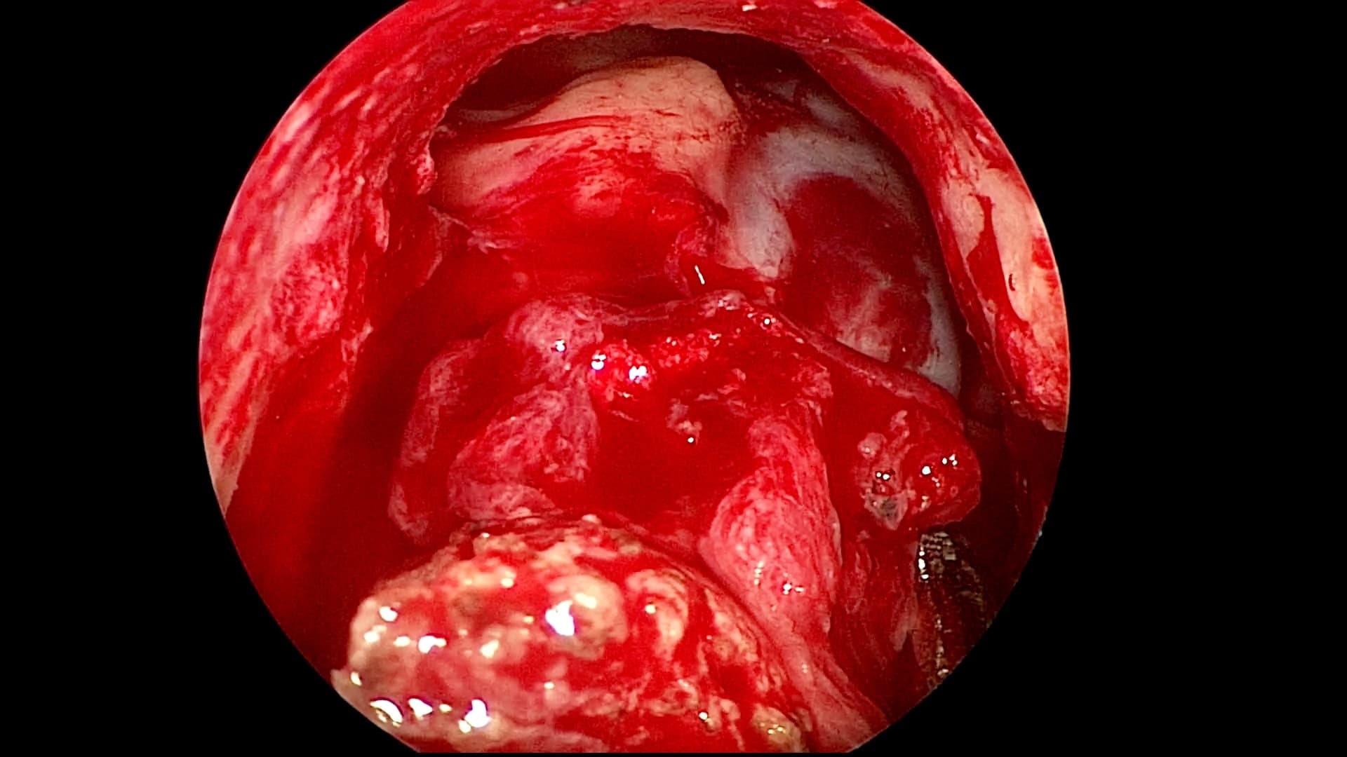 Visión endocópica endonasal donde se evidencia pared posterior del seno frontal y tumor en techo de fosas nasales invadiendo la base de cráneo.