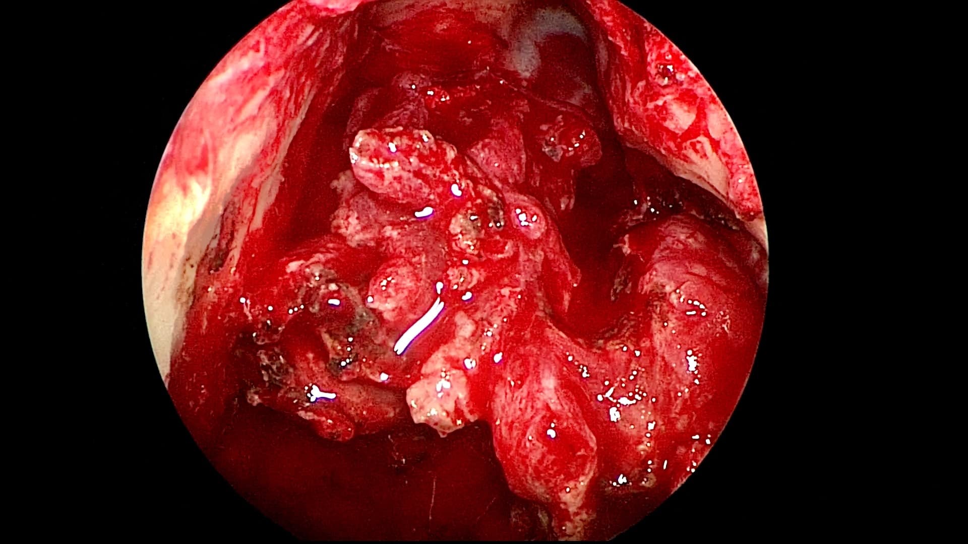 Visión panorámica del tumor en techo de fosas nasales.