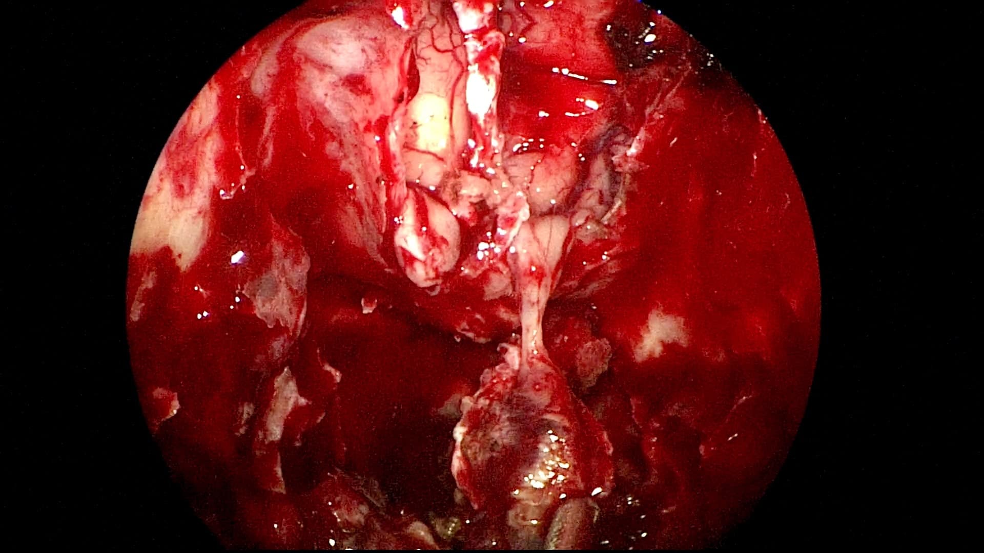 Se realiza resección dural con tumor y de comienza a exponer el cerebro desde las fosas nasales. Se observan ambos lóbulos frontales y ambos bulbos olfatorios, nótese como el tumor se propaga por el nervio olfatorio izquierdo del paciente.