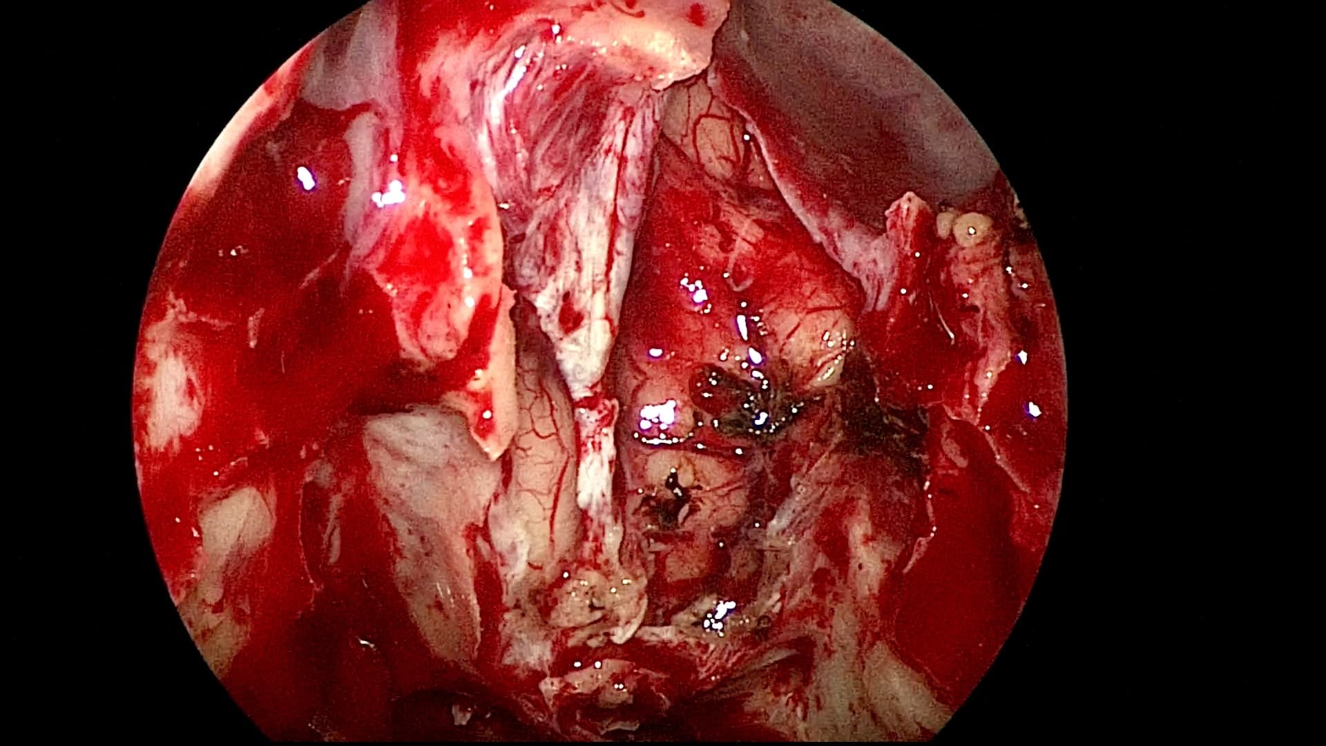 Imagen final de resección total, se evidencia gran defecto en duramadre y cerebro libre de tumor.