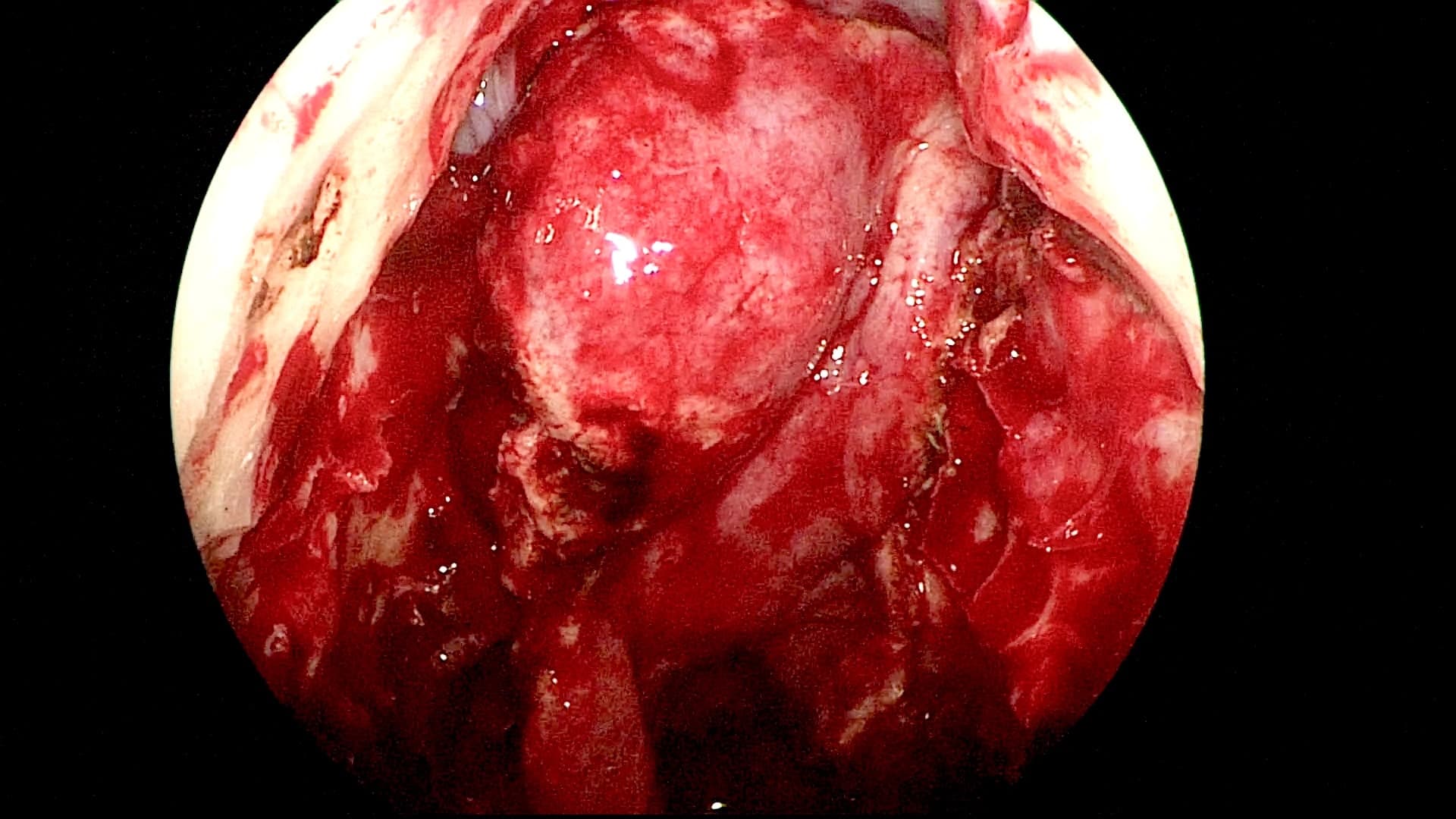 Podemos apreciar el colgajo pediculado nasoseptal descripto por el Dr Hadad* para la reconstrucción de la base del cráneo.