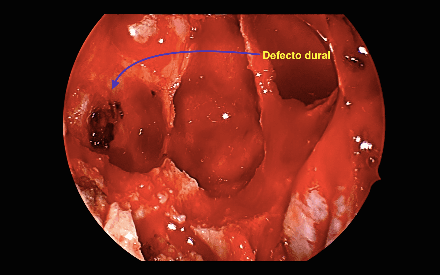 Se evidencia defecto óseo y dural en pared lateral del esfenoides.