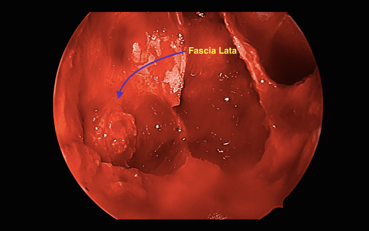 Se reconstruye plano dural con fascia lata intracraneana.
