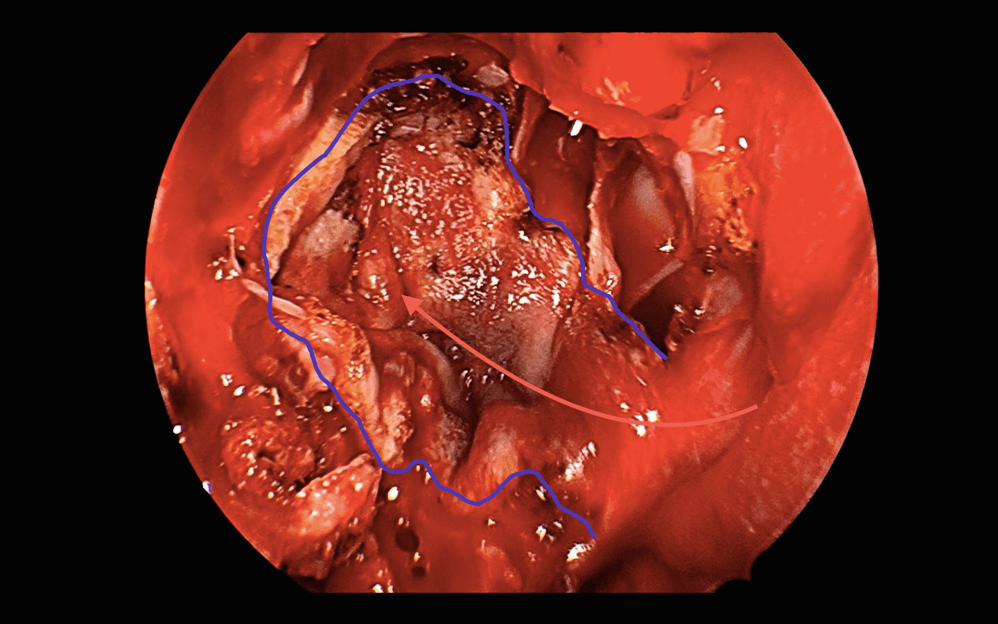 Observamos la reconstrucción de la base del cráneo con un flap nasoseptal pediculado contralateral.