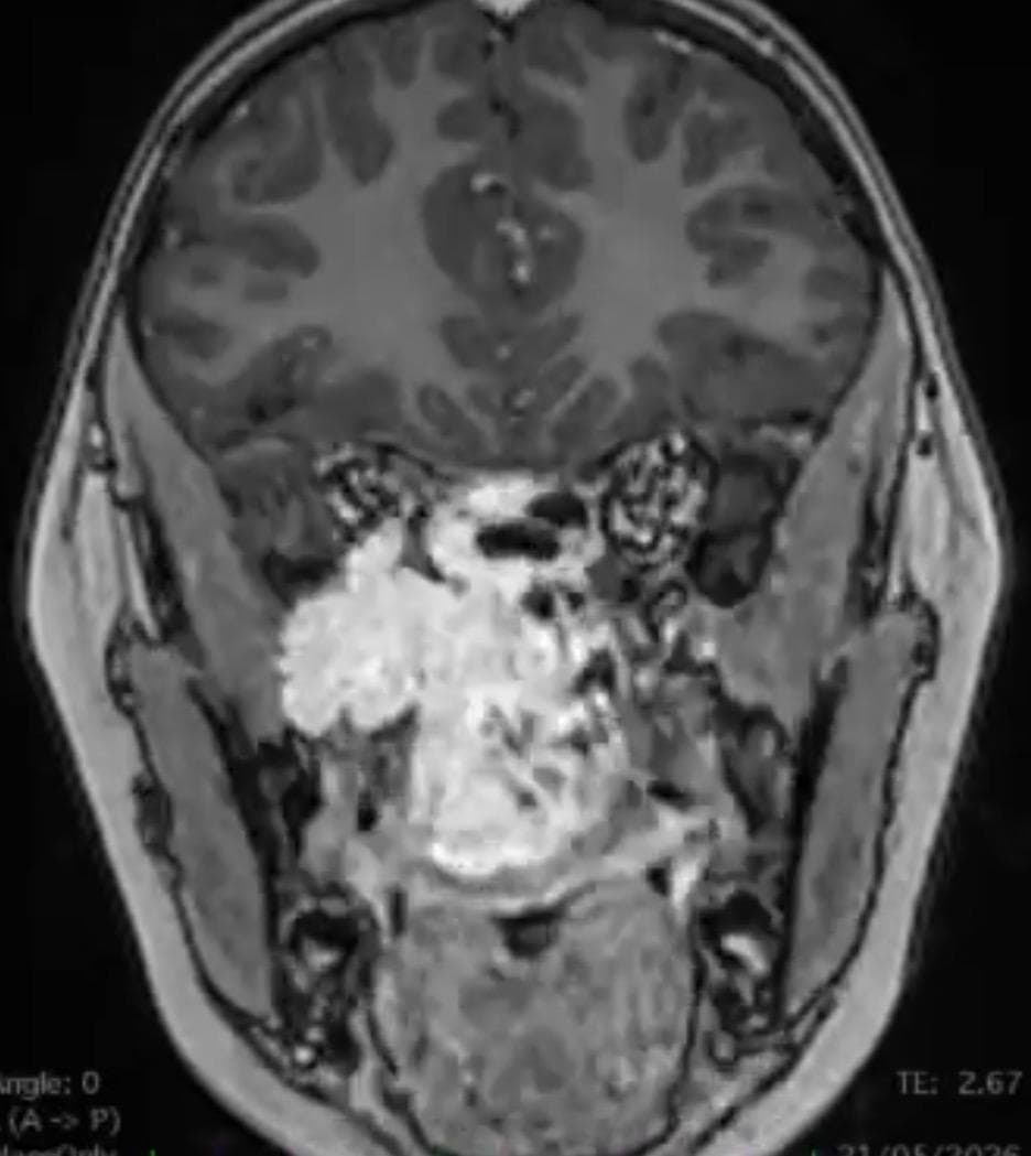 Angiofibroma nasofaríngeo juvenil gigante tratado por vía endoscópica endonasal